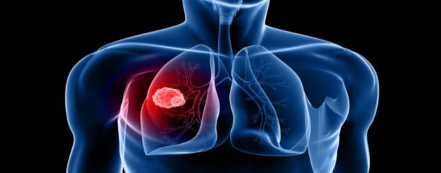 Lung Cancer symptoms, treatment, & prognosis